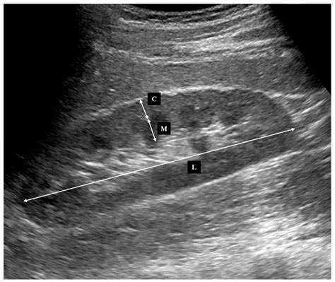 ultrasounds measure cortical thickness kidneys|echogenic kidneys with cortical thinning.